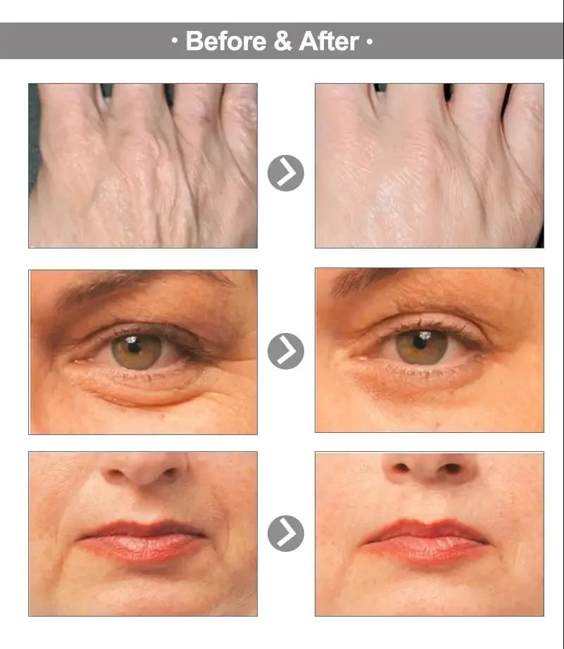 Antes e depois do uso do creme facial removedor de rugas em pele feminina com redução visível de rugas