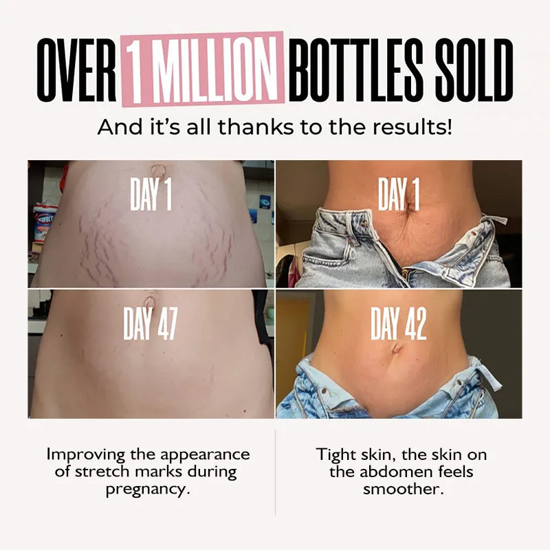 Resultados do creme para estrias na barriga BISUTANG mostrando melhora em 47 dias de uso