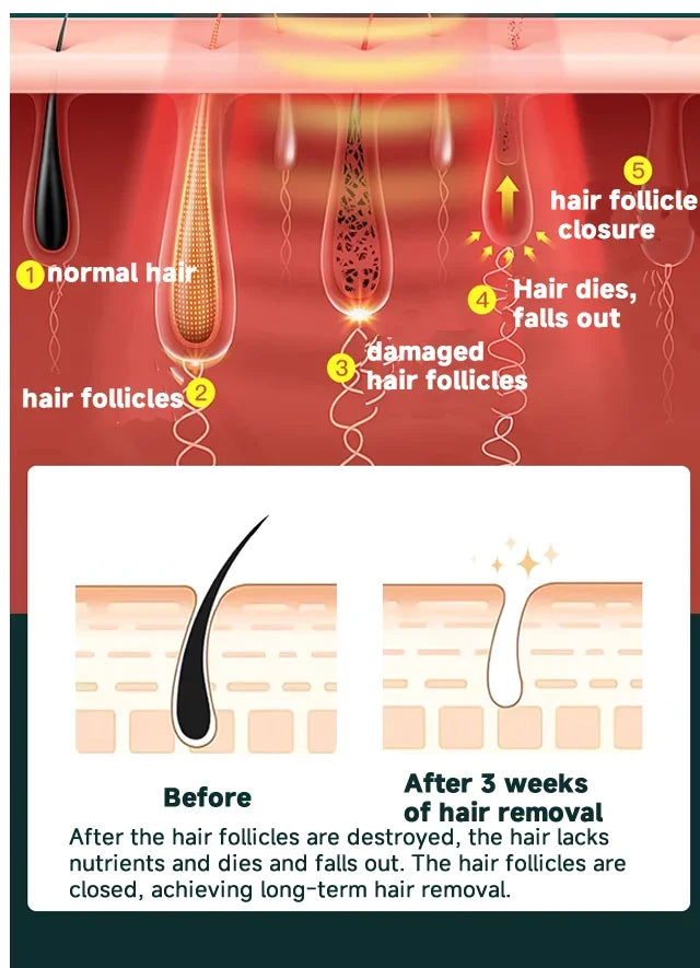 depilador a laser ipl permanente OUMONOKA ilustração de folículos antes e depois da remoção