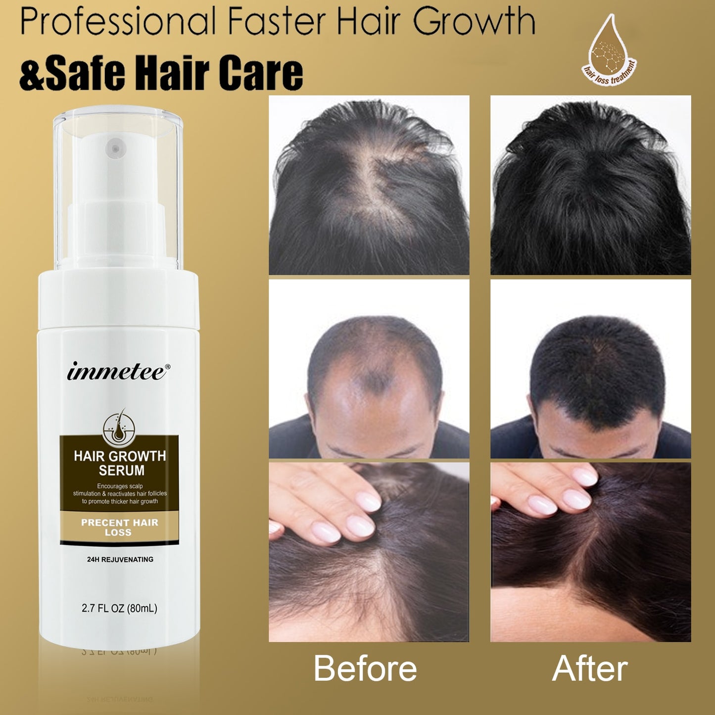 Sérum IMMETEE para tratamento anti-queda cabelo, antes e depois mostrando resultados eficazes na regeneração capilar.